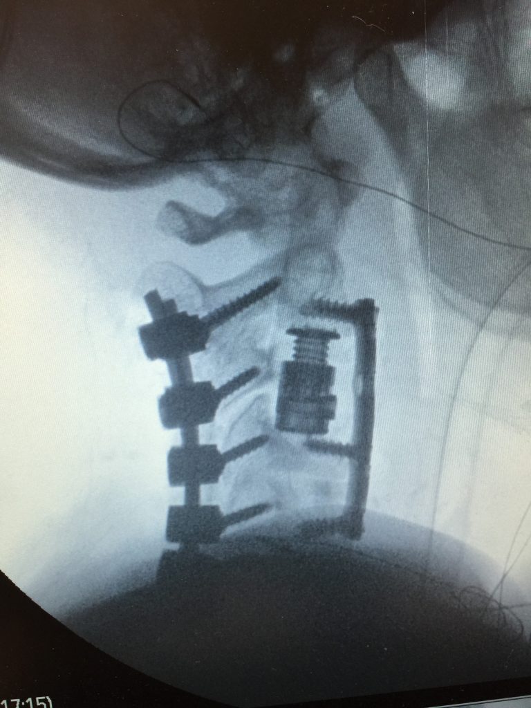 X-ray of patient’s neck following anterior corpectomy Image